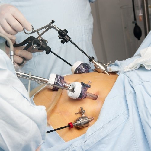 Laparoscopic Surgery in Sector 49 Gurgaon