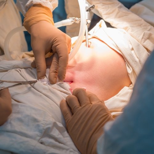 Laparoscopic Surgery in Sector 49 Gurgaon