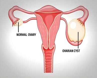 ovarian cysts
