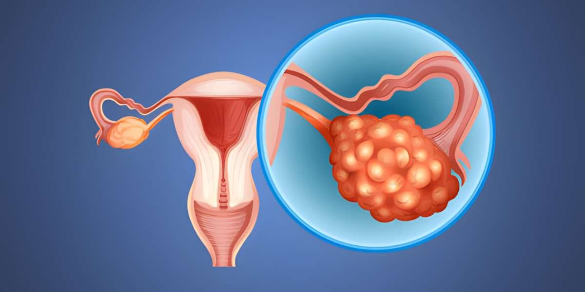 pcod treatment in sector 49 gurgaon