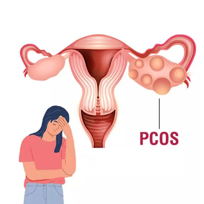 PCOD treatment in Sector 49 Gurgaon