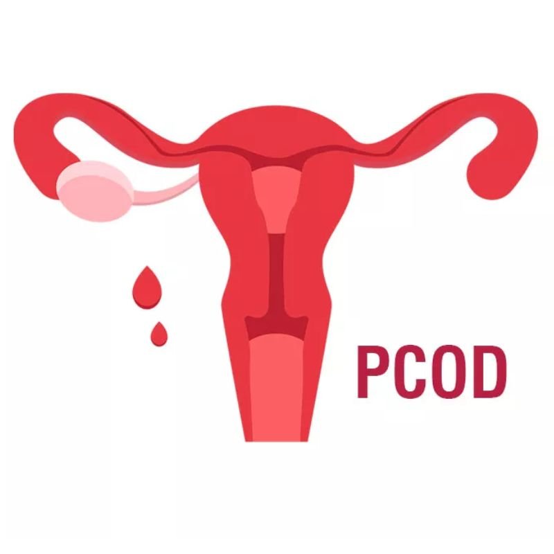 PCOD treatment