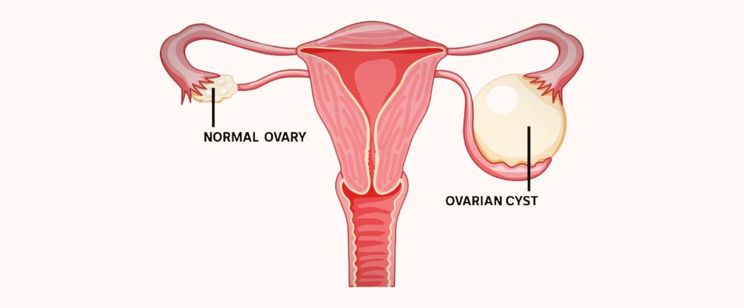 ovarian cyst removal gurgaon
