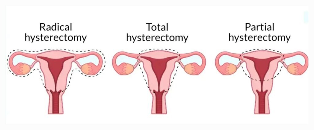 types of hysterectomy surgery sector 49 gurgaon