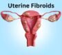 uterine fibroids 90x80