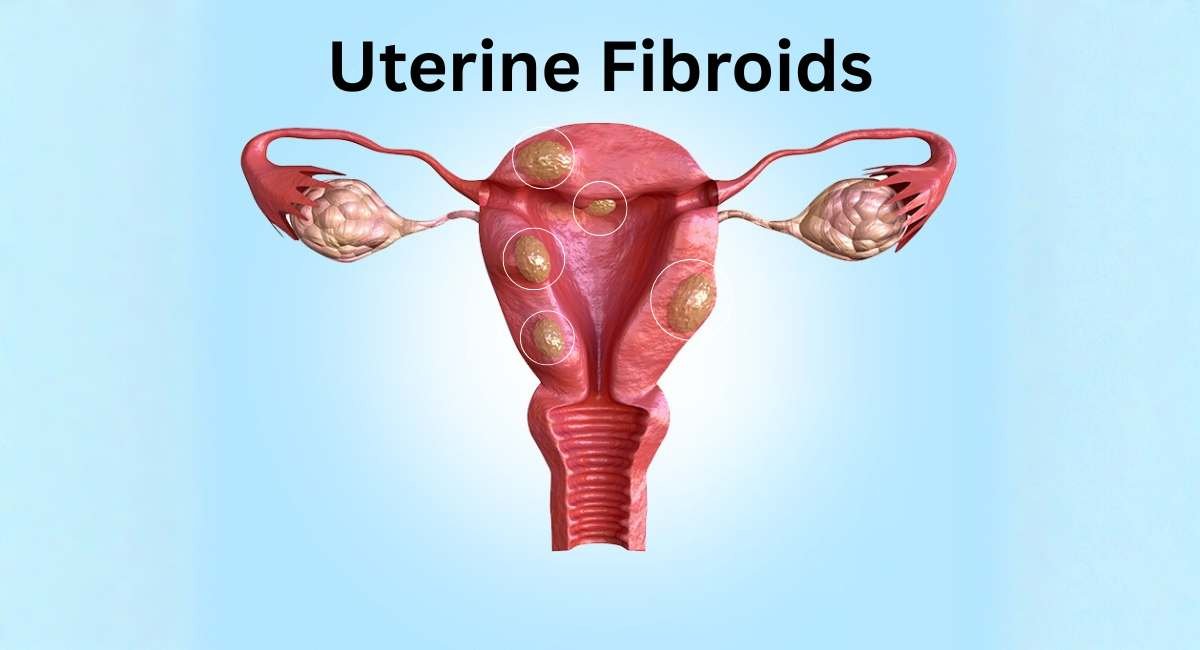 uterine fibroids