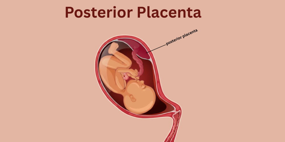 posterior placenta